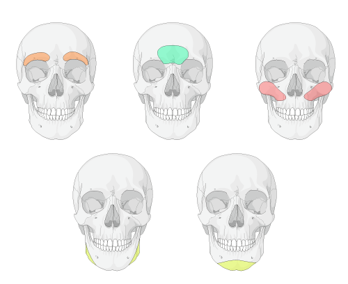 highlighed face zones for gender affirmation surgery on skull