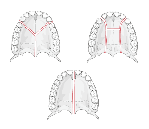 axial view of maxilla showing three types of osteotomies
