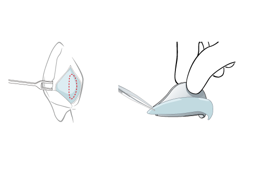 cartilage harvesting from ear and measuring on template