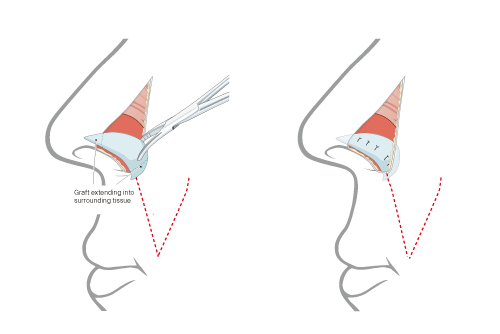 lateral view of nose showing graft placed with tips extrenting into surrounding tissues