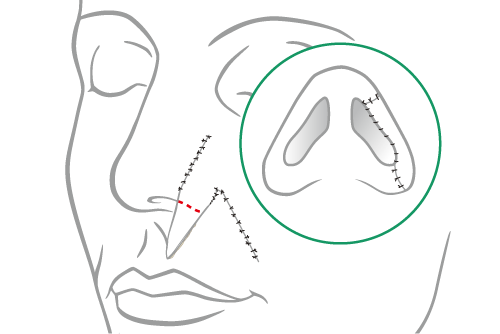 final surgical step of small superficial nose defect repair