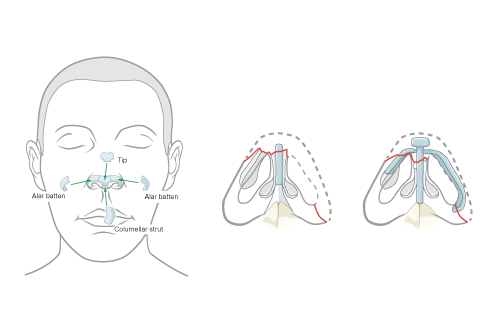 face highlighting anatomy of nose with cartilage repair need for tip reconstruction