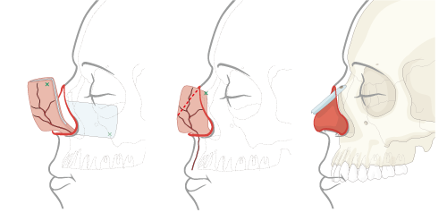 lateral view of face with septum used as flap for central support