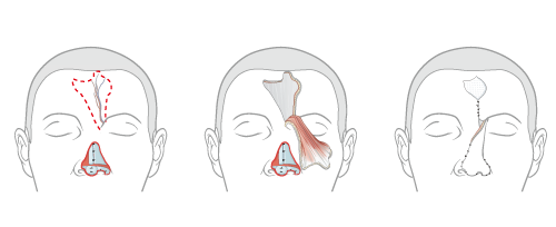 anterior view of face with three surgical stage for thick, deep defect reconstruction