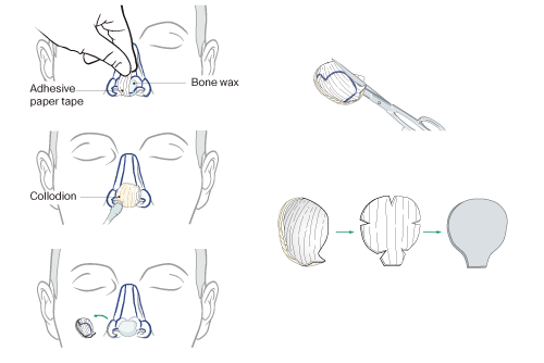 steps visualised to create defect templates for tip and alar reconstruction