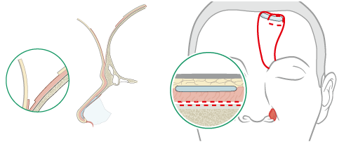 cross section of skin layers on forehead flap
