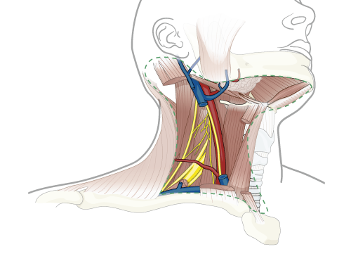 oral cancer project image of neck dissection
