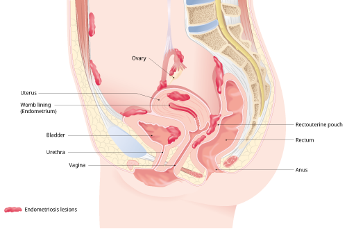 lateral crosssection through female genital organs highlightening endometriosis lesions