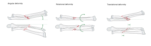 pediatric forearm bones showing angular, rotational and translational deformity