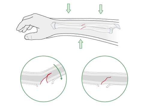 reduction through cast molding for greenstick fractures in children