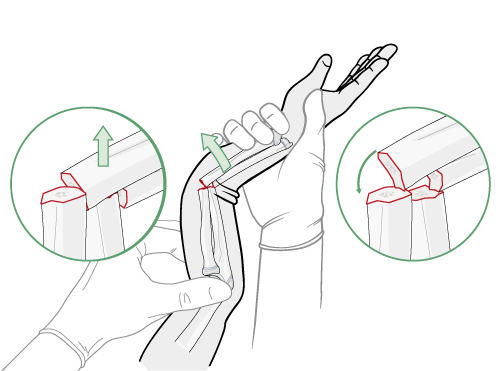reduction maneuver for forearm fracture in child