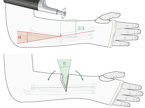 reduction after cast application