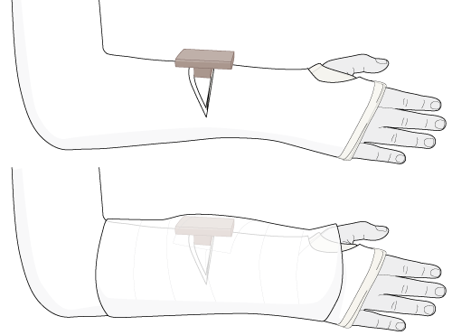 reduction after cast application