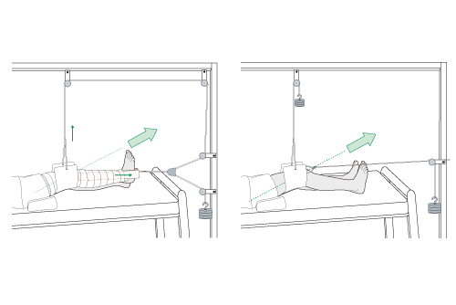 two situations of longitudinal traction with children legs
