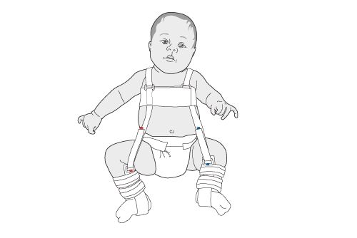 baby with pavlik harness