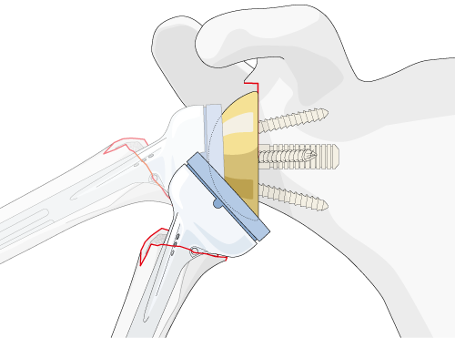 reduction and assessment of joint tensioning and stability with trial implant