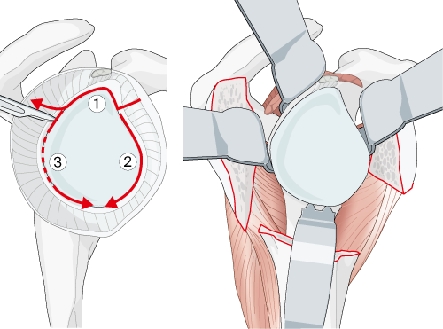 glenoid-sided soft-tissue release
