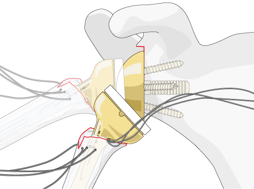 surgical step of reduction of prosthesis