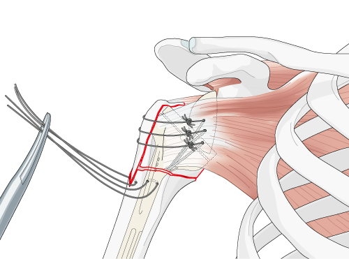 surgical step of reduction of tuberosities