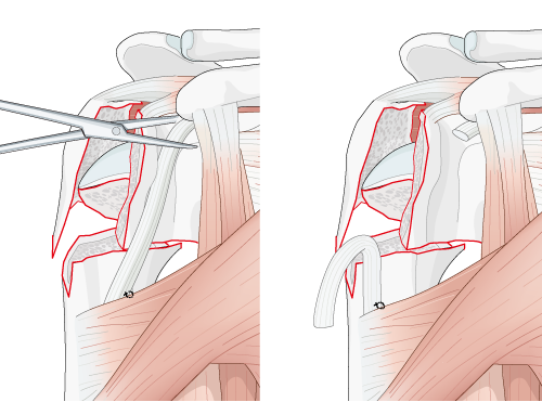 lateral should with c-type fracture. Surgical step of tenotomy