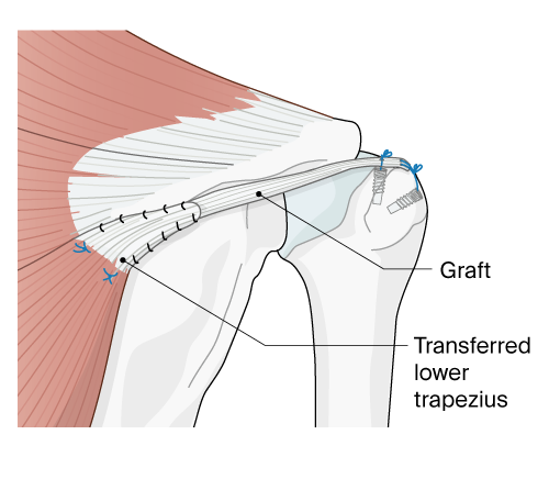 medical illustration of trapezius muscle transfer and rotator cuff repair
