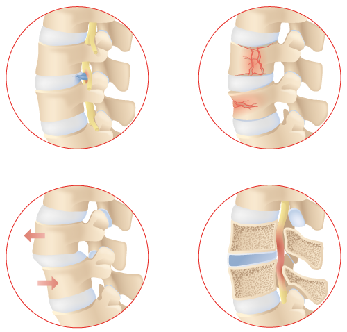 four lateral views of vertebra with disc herniation, body fracture, spondylolisthesis, and spinal stenosis