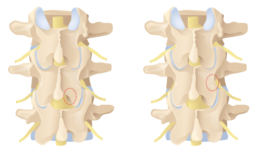 posterior view of lumbar spine showing medial and lateral portal