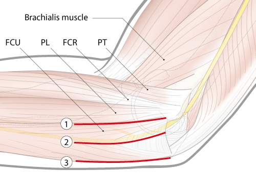 lateral elbow with incision lines for three approaches