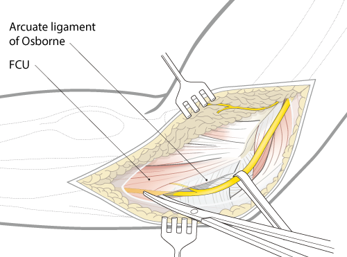 lateral elbow with approach step cutting through fascia
