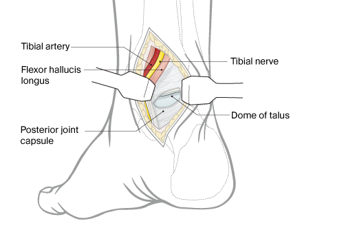 posterior approach to talus