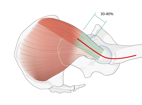 approach step image incision into gluteus muscle