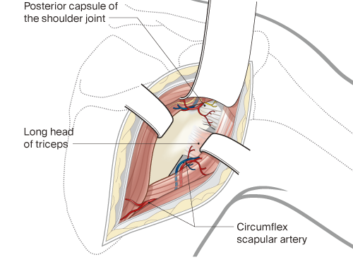 approach to posterior scapula visualizing capsule and circumflex scapular artery