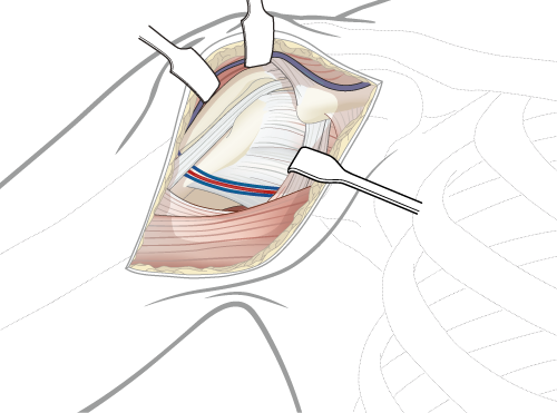 deltopectoral approach to proximal humerus